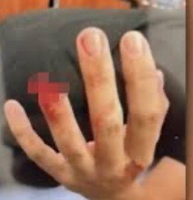 NYPD officer’s finger bit off!