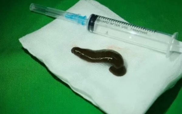 A sore throat caused by a leech.