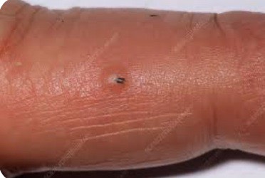 Splinter removal, infections