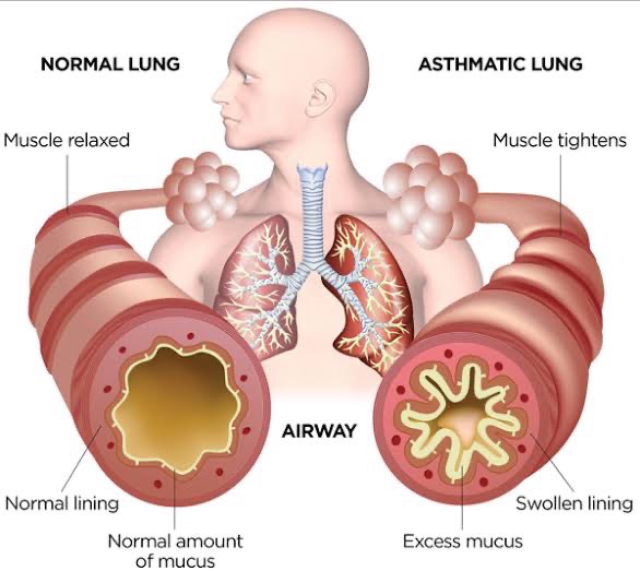 ASTHMA from BAD POSTURE & INDIGESTION?