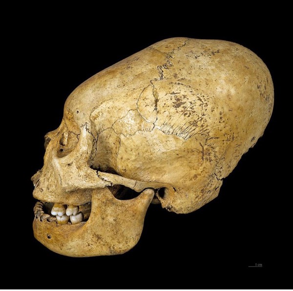 Longheads Cranial Deformation