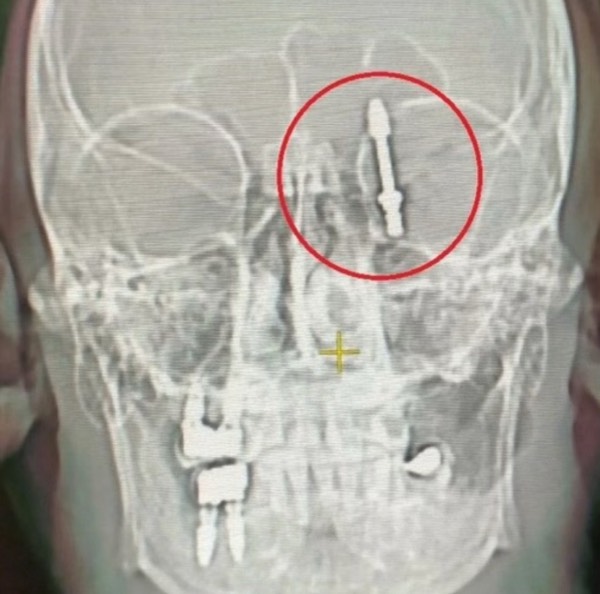 #1476 Dentist Pushes Implant Screw into Man’s Brain!