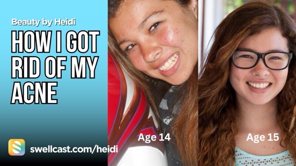 How I Got Rid of My Acne/- My Personal Journey & Tips! #beautybyheidi #skincare #beauty #acne